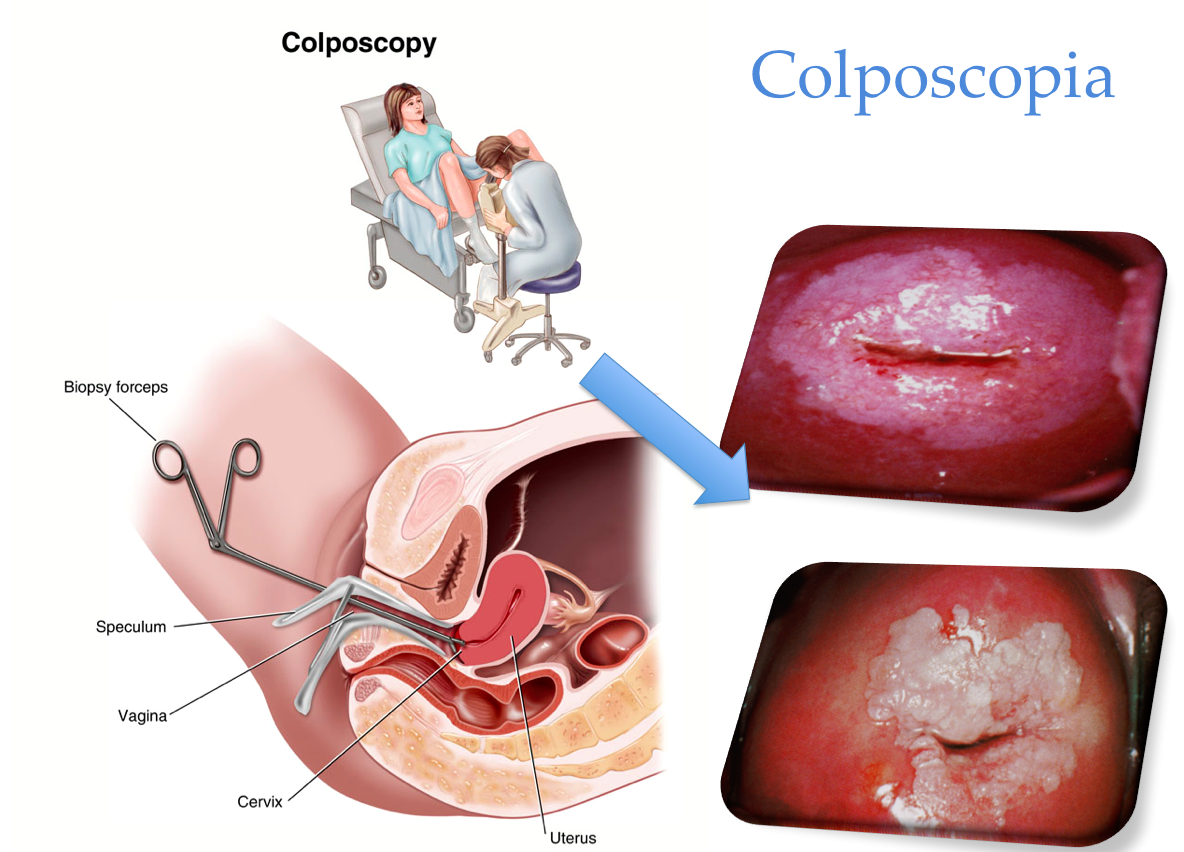 Colposcopia