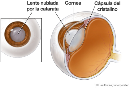 anatomia ojo catarata