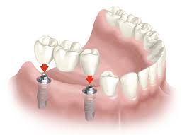 IMPLANTES DENTALES